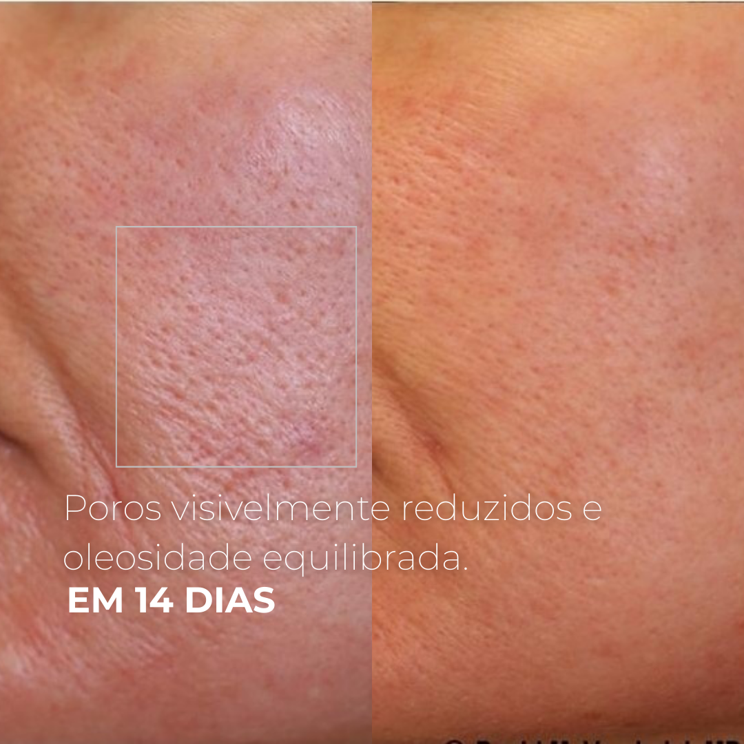 PICOTAGE – Peeling com Microspículas