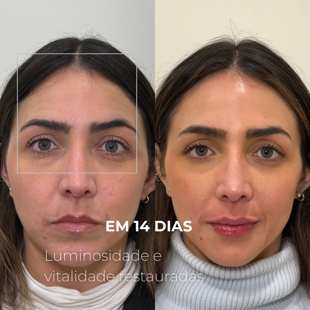 EXOMAGE – Booster de PDRN com Exossomos