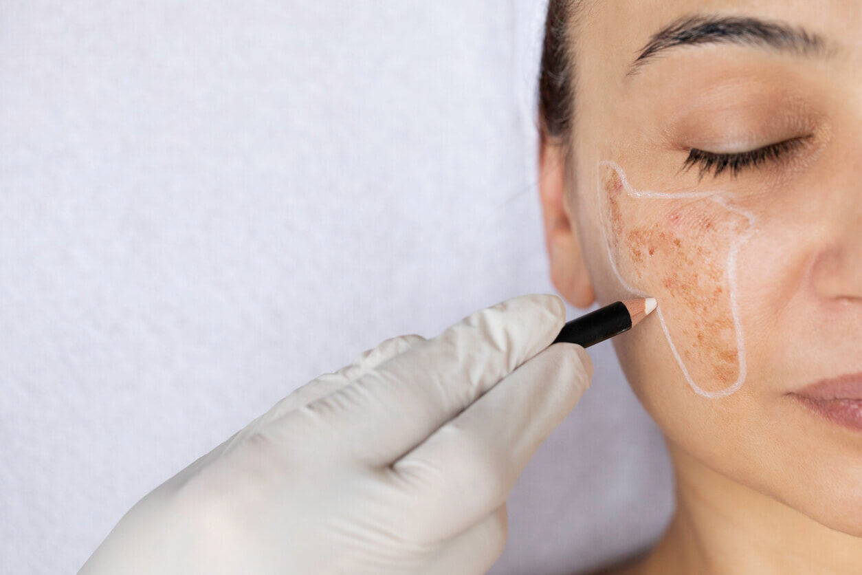 Melasma resistente: O protocolo completo para quem já tentou de tudo