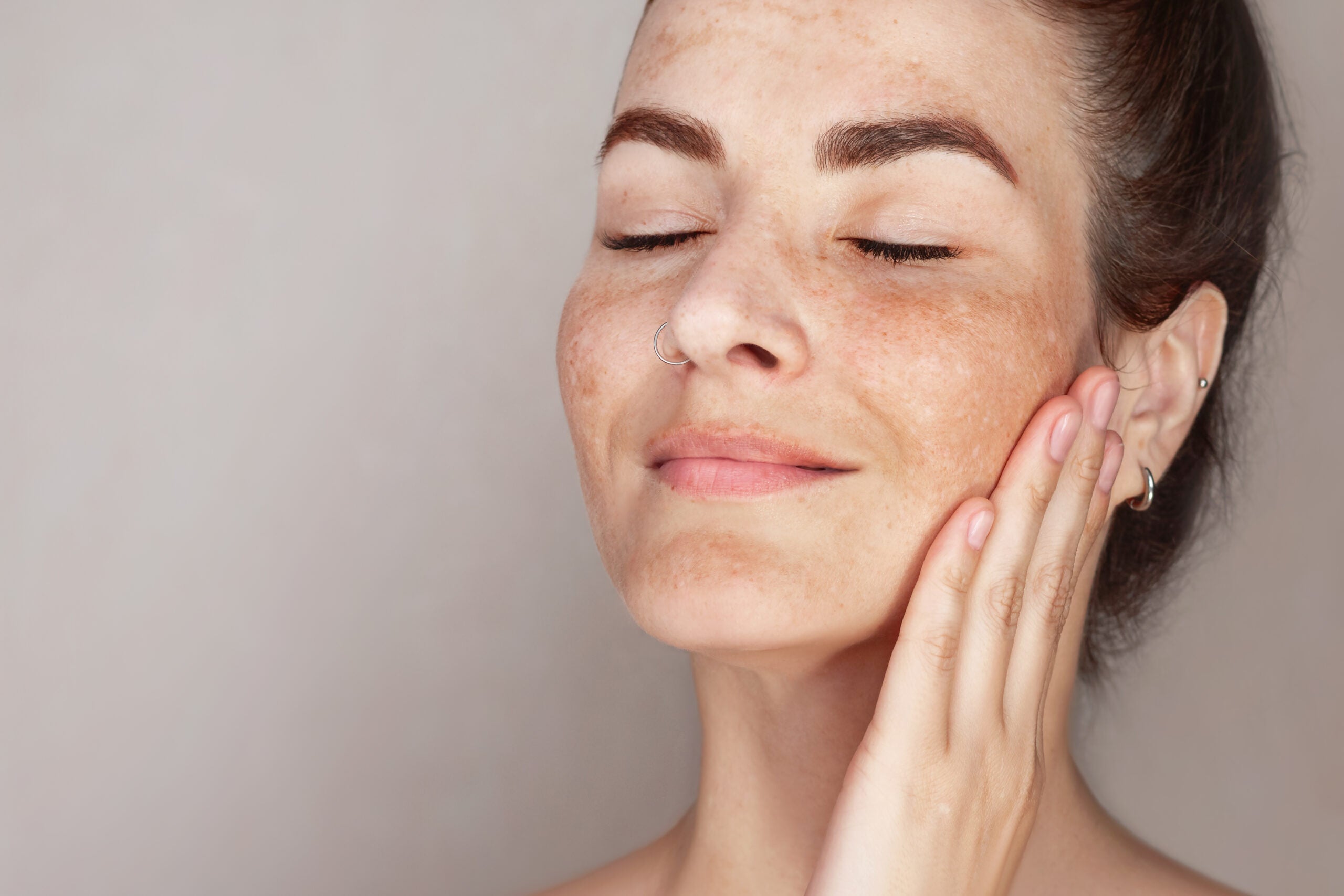 Melasma no inverno: Por que esta é a melhor época do ano para tratar