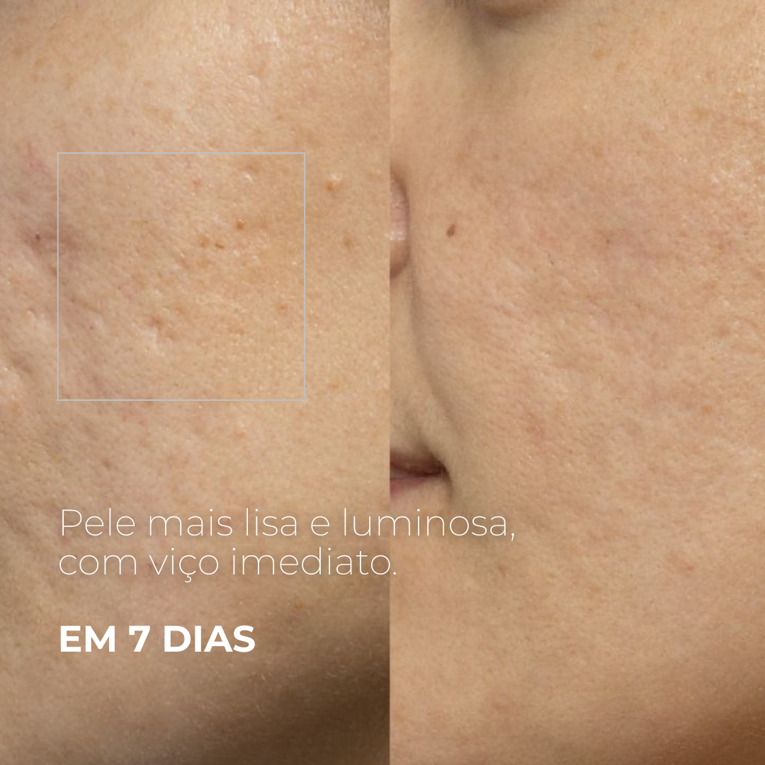 PICOTAGE – Sérum Peeling com Microspículas (Microagulhas)