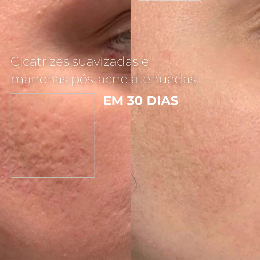PICOTAGE – Sérum Peeling com Microspículas (Microagulhas)