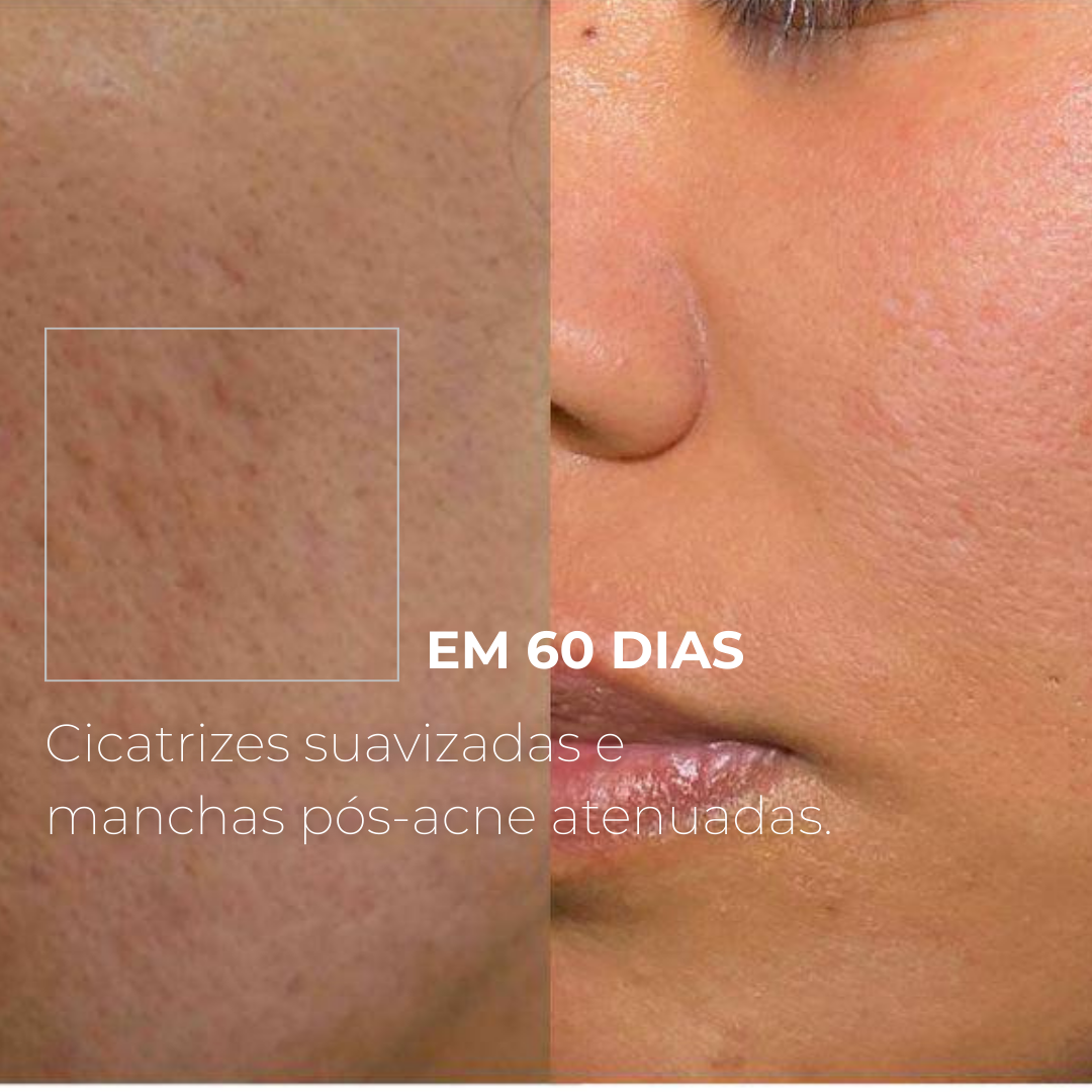 PICOTAGE – Sérum Peeling com Microspículas (Microagulhas)